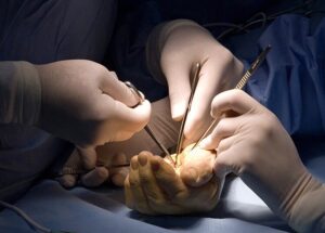 hand-surgery