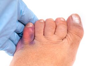 hurst-podiatry-australia-blog-soft-tissue-foot-injury-explained