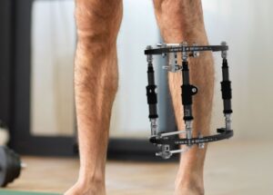 qa-on-post-operative-management-of-deformity-correction-surgery-with-external-fixation