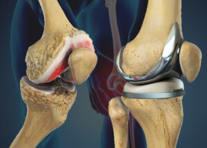 totalkneereplacement