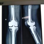 Fracture Treatment in Kolkata: What to Do in the First 24 Hours