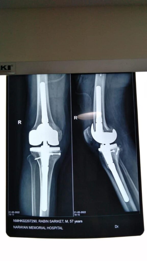 fracture treatment in kolkata