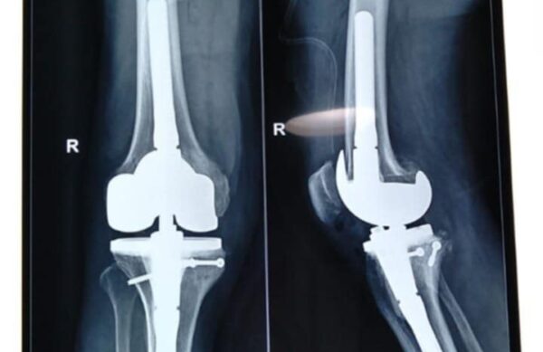 fracture treatment in kolkata