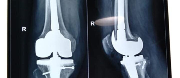 fracture treatment in kolkata