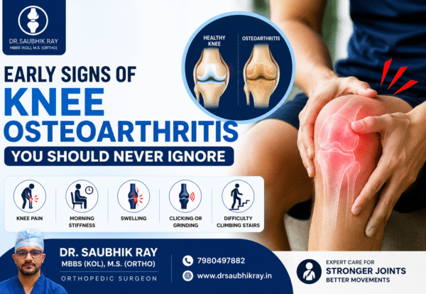 Early Signs of Knee Osteoarthritis You Should Never Ignore